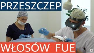 Przeszczep włosów metodą FUE - na czym to polega?