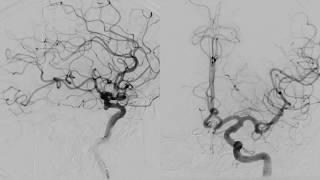 Aneurysm A  CoA    Barrel