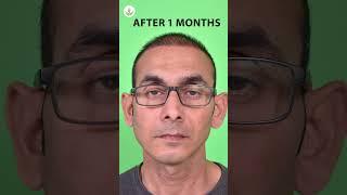 Hair Transplant After 1 Month Before & After Results: Transform Your Look  #shorts