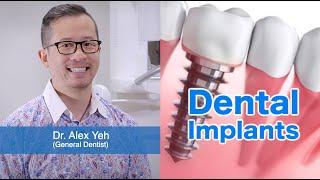 DENTAL IMPLANTS - Frequently Asked Questions