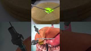 How Laparoscopic Surgery Works