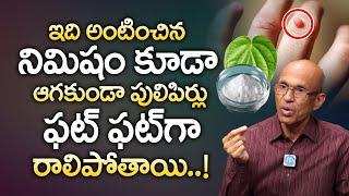 Dr Madhusudhan - నొప్పి లేకుండా పులిపిర్లు మాయం || Home Remedies For Pulipirlu || iDream Doctors