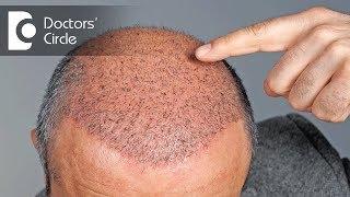 Side effects of Hair Transplant - Dr. Vivekanand Bhat