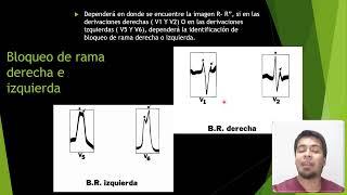 bloqueo de rama