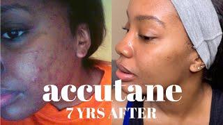 7 Years POST ACCUTANE Update | Side Effects, My Skin Now + Skincare Tips