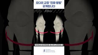 오다리 교정 수술은 이렇게 하시면 안 됩니다 #오다리 #오다리교정 #shorts #fyp #관절염