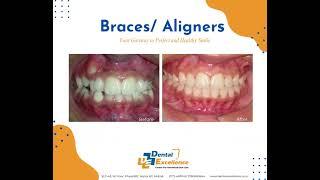 Braces/ Aligners Your Gateway to Perfect & Healthy Smile!!!