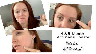 Accutane and Depression Side Effect | Month 4&5 | Hair Loss | Extreme Joint Pain