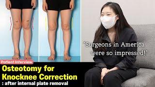 [ENG]Osteotomy for Knocknee Correction Patient Interview‍️