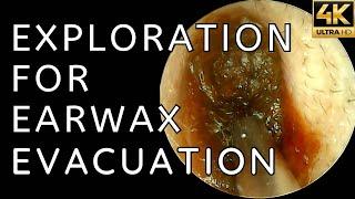 An Exploration For Earwax Evacuation (4K 60FPS)