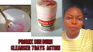 HOW TO PROMIX QUICK CLEAR BEST EFFECTIVE  SUNBURN CREAM ERASER.  7DAYS RESULT .