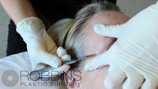 Non-Surgical Treatment for Anti- Aging Dermaplane Procedure- Robbins Plastic Surgery in Nashville TN