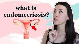 What Is Endometriosis? | Symptoms, Diagnosis, Treatment