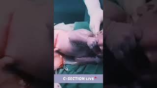 LIVE C-Section (Cesarean Delivery) | ऐसा सिज़ैरीअन डिलीवेरी नहीं देखा होगा! 🫢 #baby #csectionmom