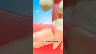 Impacted Wisdom Tooth Removal – What Really Happens  #short  Creativelearning3d