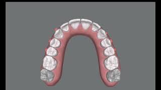 Simple alignment with Invisalign. clincheck project ready to send to the patient.