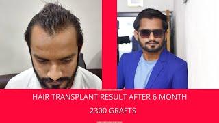 Hair Transplant Result 2021 || NW Grade2||  2300 Grafts|| Hair Transplant Clinic