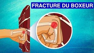 FRACTURE DU CINQUIÈME MÉTACARPIEN (Fracture du boxeur) : Diagnostic et Traitements