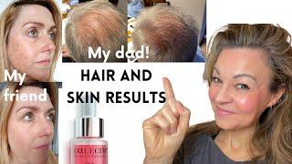 My 79-yr-old Dad's Surprise Hair Regrowth with Calecim Professional!