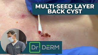 Multi-Seed Layer Back Cyst | Dr. Derm