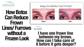 Proper Botox® Administration for Forehead Frown Lines Won't Result in "Frozen" Look