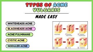 Acne vulgaris, types of acne, acne types and treatment, dermatology made simple