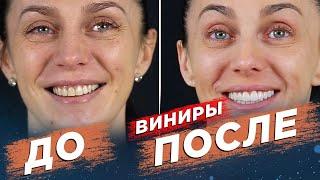 Керамические виниры. Виниры ДО И ПОСЛЕ. Ceramic veneers