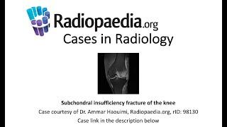 Subchondral insufficiency fracture of the knee (Radiopaedia.org) Cases in Radiology