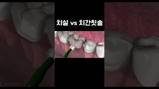 치실 vs 치간칫솔ㅣ치과의사의 선택은?