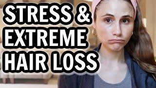 Tips for EXTREME HAIR LOSS from STRESS Dr Dray