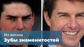 Зубы знаменитостей до и после стоматолога