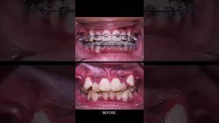 Niềng răng tại Ocare sau 18 tháng #braces #orthodontic