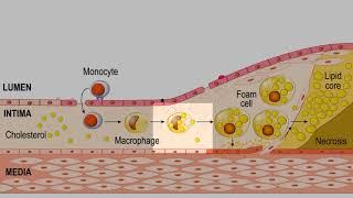 LDL CHOLESTEROL! FOAM CELLS! PLAQUE! ATHEROSCLEROSIS! EXPLAINED!