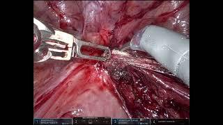 Persistent endometriosis following hysterectomy.