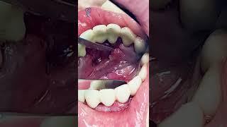 Зубной камень захватил полость рта. Tartar has invaded the oral cavity.