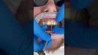 Predesigned composite veneers technique #dentist #shorts