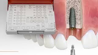 BioHorizons FSK5000 | Step-by-Step Drill Sequence for Pro Freehand Surgical Kit