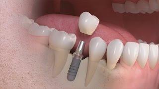 Straumann - Trattamento singolo dente su impianto