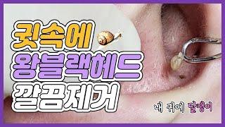 속 시원한 귀 피지 제거, 대왕 블랙헤드가 쏙쏙 나오는 영상 Giant blackhead in ear, blackhead removal