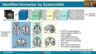 Talk: DystoniaNet: A Deep Learning Platform to Diagnose Dystonia from Raw Structural MRI