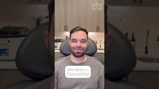 Before + After: Botox with Chemical Peel