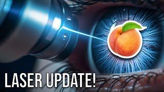 LASER Surgery Update! | Hemorrhoids, Anal Fistula, Pilonidal Cyst