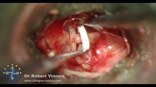 Primary Otosclerosis "A to Z". Entire procedure. Dr Robert Vincent, Causse Ear Clinic