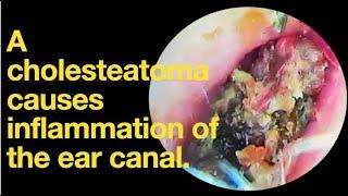 A cholesteatoma causes inflammation of the ear canal.|ear wax removal | ear cleaning | ASMR