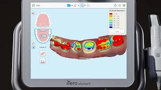 iTero® Scanner Tutorial: Post Scanning Case Review