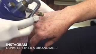 Treating age spots / liver spots on the hands. For medical education- NSFE