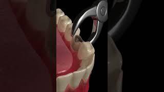 Animated Dental Extraction Procedure