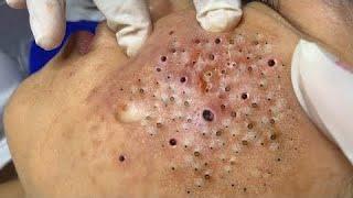 Big Cystic Acne Blackheads Extraction Blackheads & Milia, Whiteheads Removal Pimple Popping