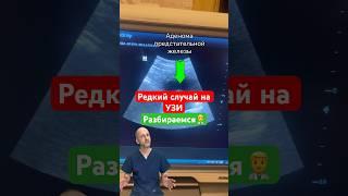 Редкий случай | Мочевой пузырь узи с рассказом #доктор #узи #топ #онкология #рассказ