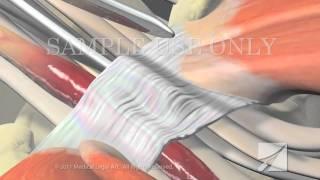 Carpal Tunnel Syndrome with Surgical Release